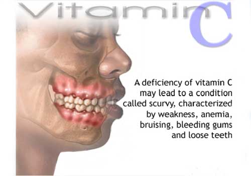 Значительному снижению защитных сил организма  способствует недостаток витамина С.