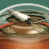 Возвращение зрения при помощи имплантации хрусталика