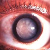 Лечение катаракты в медицинских центрах за рубежом