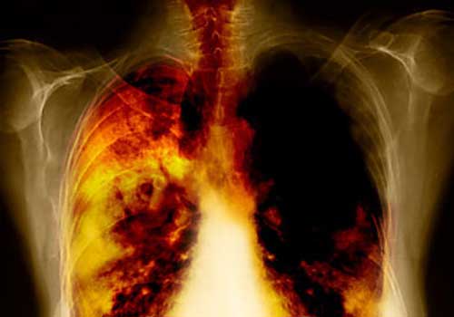 Острыми или хроническими заболеваниями горла, бронхов и легких страдают многие курильщики.