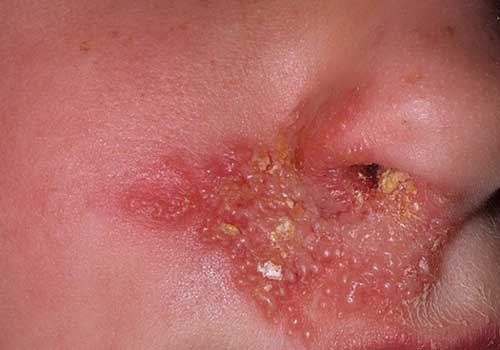 Вирус может проявиться на коже лица, губах и других местах, как только иммунная система даст сбой.