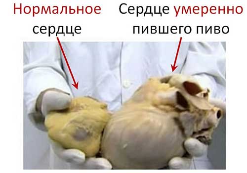 Фотография. Не кликабельно. Употребление пива приводит к расширению полостей сердца, увеличению его стенок, а также некрозам в сердечной мышце.