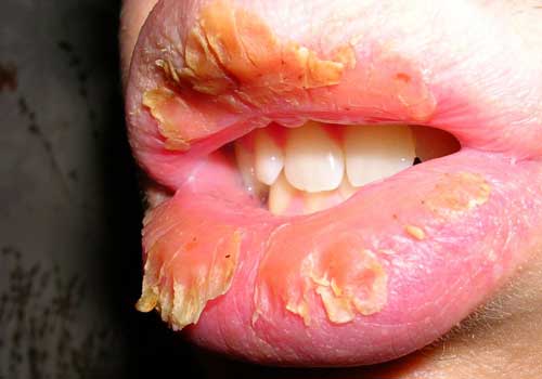 Кожа губ начинает трескаться при недостатке в организме таких витаминов как В2 и А.