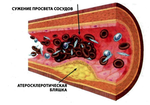 При атеросклерозе засоряется стенка артерий и уменьшается доступ крови к органам и тканям. Это ведет к ишемии и дальнейшей гибели клеток.